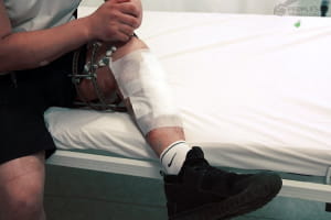 Вже по операції: ногу вбрали у апарат Ілізарова