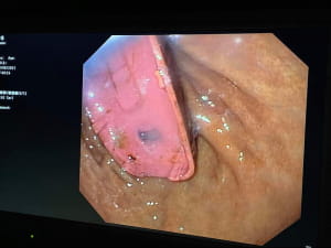 Операція з порятунку чоловіка, який проковтнув телефон