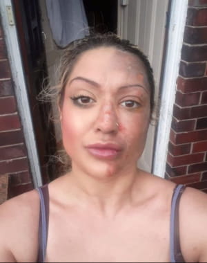 Жінка отримала серйозні опіки обличчя через лайфхак з TikTok