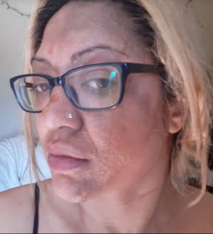 Жінка отримала серйозні опіки обличчя через лайфхак з TikTok