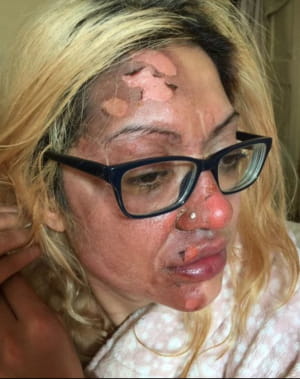 Жінка отримала серйозні опіки обличчя через лайфхак з TikTok