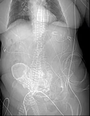 Історія незавершеної вагітності