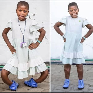 До и после операции и лечения болезни Блаунта, нарушение роста берцовой кости