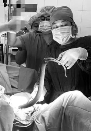 Операція з видалення вугра