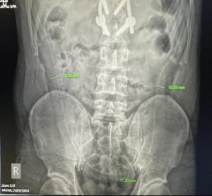 Операція з видалення вугра