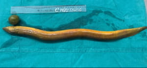 Операція з видалення вугра