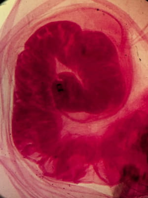 Інфекція Taenia solium