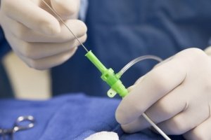 Невідкладна операція для пацієнтів з інфарктом міокарда в Україні буде безкоштовною - МОЗ