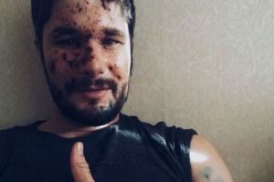 Поранений в Авдіївці британський журналіст розповів, як нині почувається 