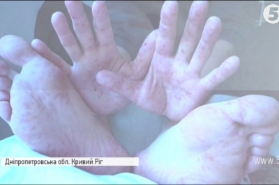 вірус Коксакі