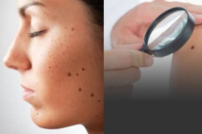 Перевірка родимки, меланома