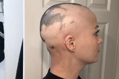 Потеря волос