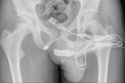 Хлопець виміряв свій пеніс USB-кабелем