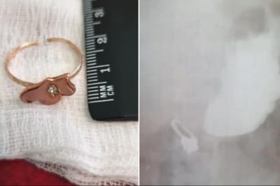 Дитина проковтнула каблучку