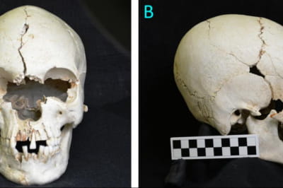 Череп женщины, болевшей проказой