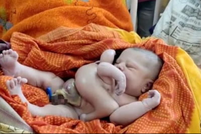 Немовля з 8 кінцівками