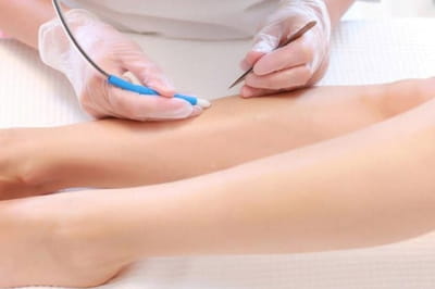 Лазерная эпиляция