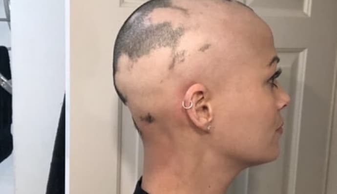 Втрата волосся