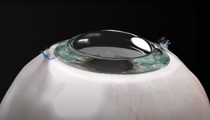 Штучна рогівка