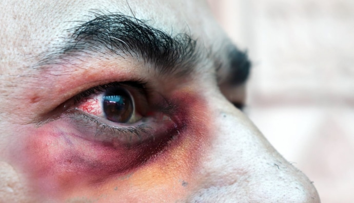 Мукормікоз