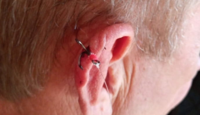 В Одессе рыбак "пробил" себе ухо