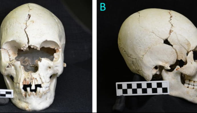 Череп жінки, яка хворіла на проказу