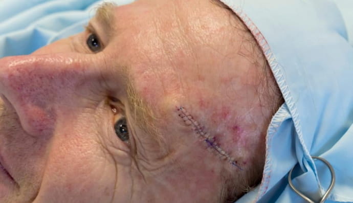 Базальная клеточная карцинома