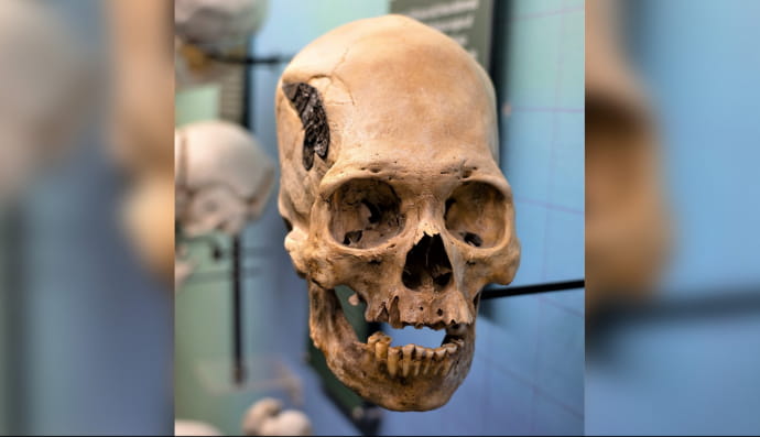 Череп с признаками уникальной операции