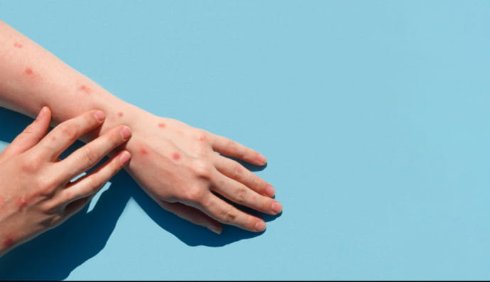 Мавпяча віспа