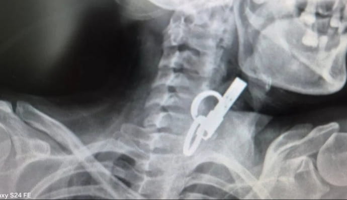 Жінка проковтнула ключі