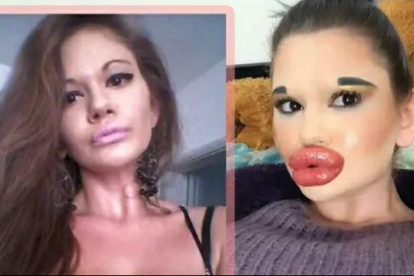 Дівчина збільшувала губи 26 разів