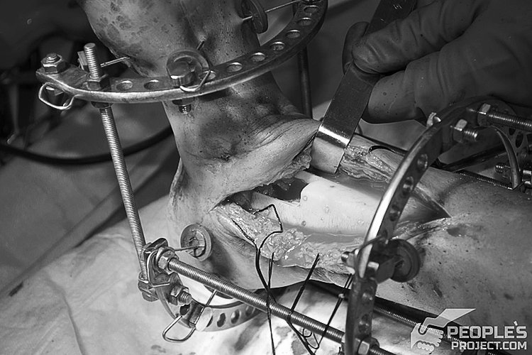 Поранений боєць став на ноги